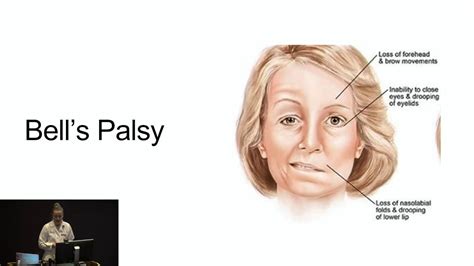 post bell's palsy neuralgia